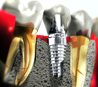 implant